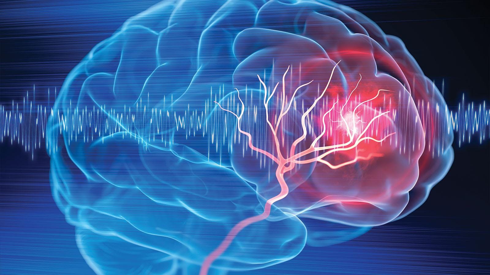 3D illustration of a brain stroke